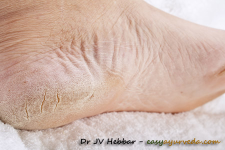 How to treat cracked heels! | Daily Sun
