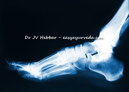 Are you Suffering from Heel Spurs? The Prolotherapy Clinic