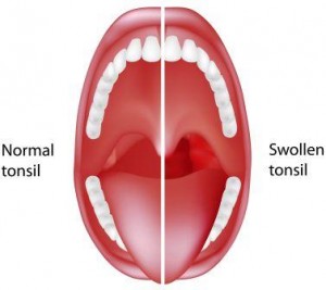 Tonsillitis Ayurvedic Treatment, Herbs, Home Remedies