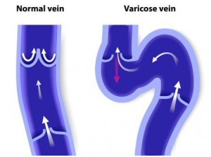 Varicose Veins - Ayurvedic Treatment, Herbs, Home Remedies