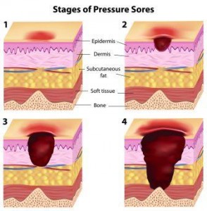 Bed Sores - Ayurvedic Medicines, Home Remedies ⋆ Easy Ayurveda