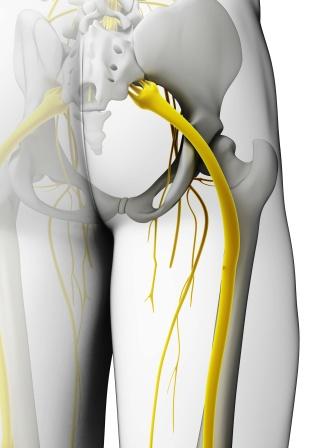 Pain in the butt? It could be Piriformis Syndrome! - Triangle