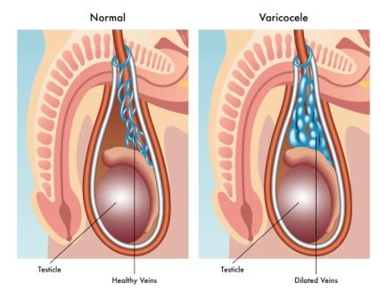 Varicocele: Causes, Symptoms, Differential diagnosis, Treatment