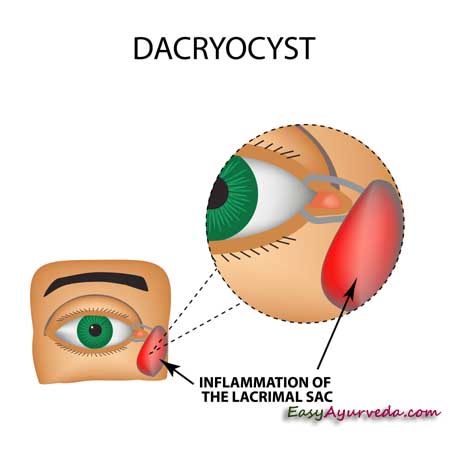 lacrimal caruncle